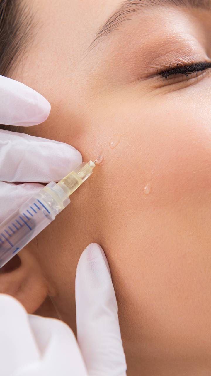 Acne Steroid Injection - Allure Aesthetics