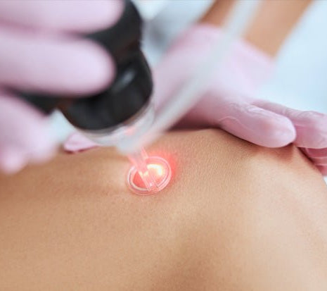 Laser Vein Treatment - Medium Area - Allure Aesthetics