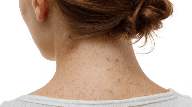 Light & Bright - Neck - Allure Aesthetics