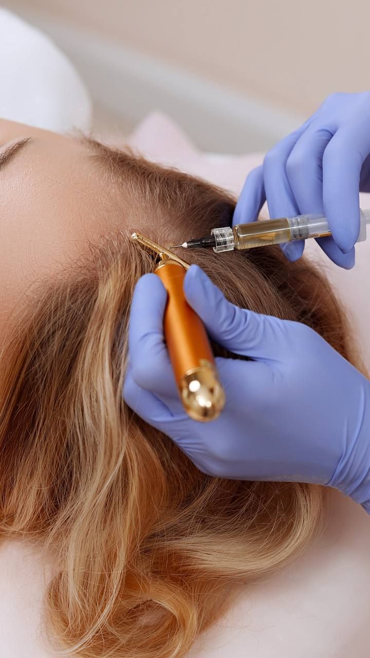 Hair Restoration with PDRN (Vamp) or Exosomes - Allure Aesthetics