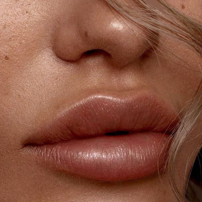 Lip Augmentation - Allure Aesthetics