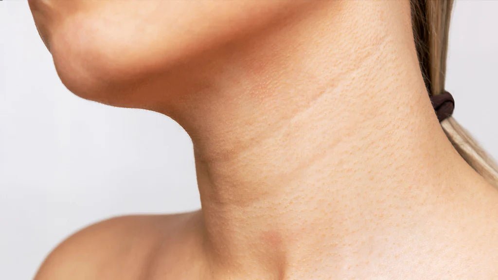 Microneedling - Neck - Allure Aesthetics