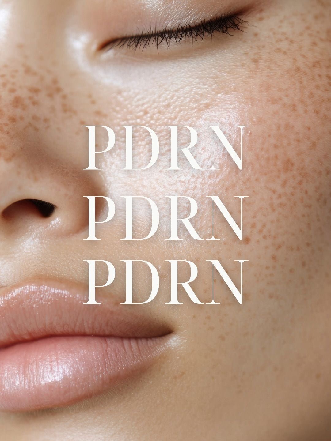 Microneedling with Salmon DNA (Vamp) PDRN - Allure Aesthetics