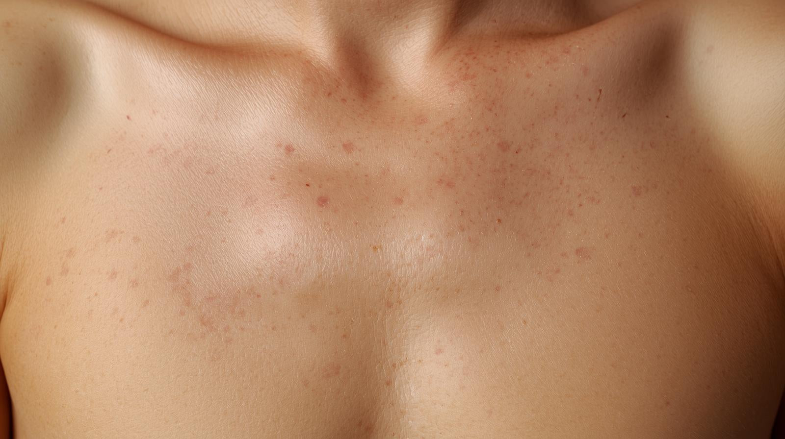 Photofacial - Chest - Allure Aesthetics