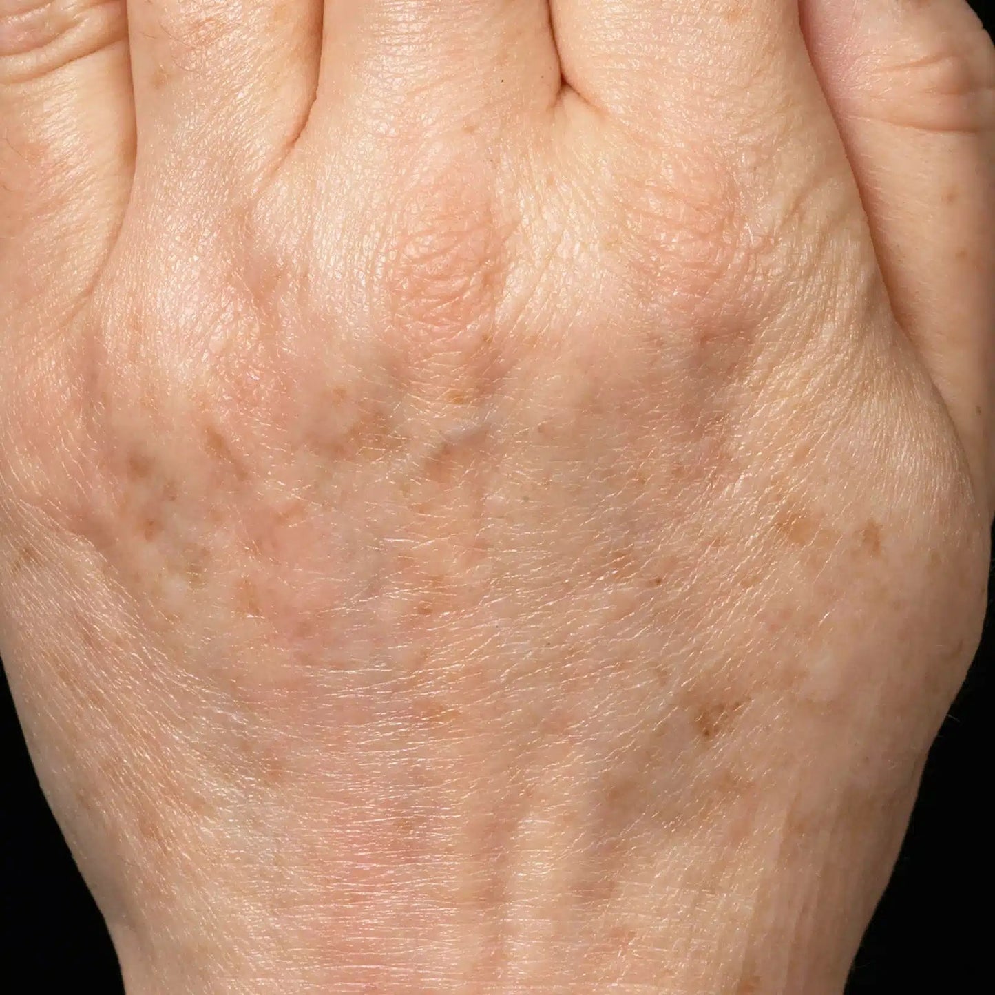 Photofacial - Hands - Allure Aesthetics