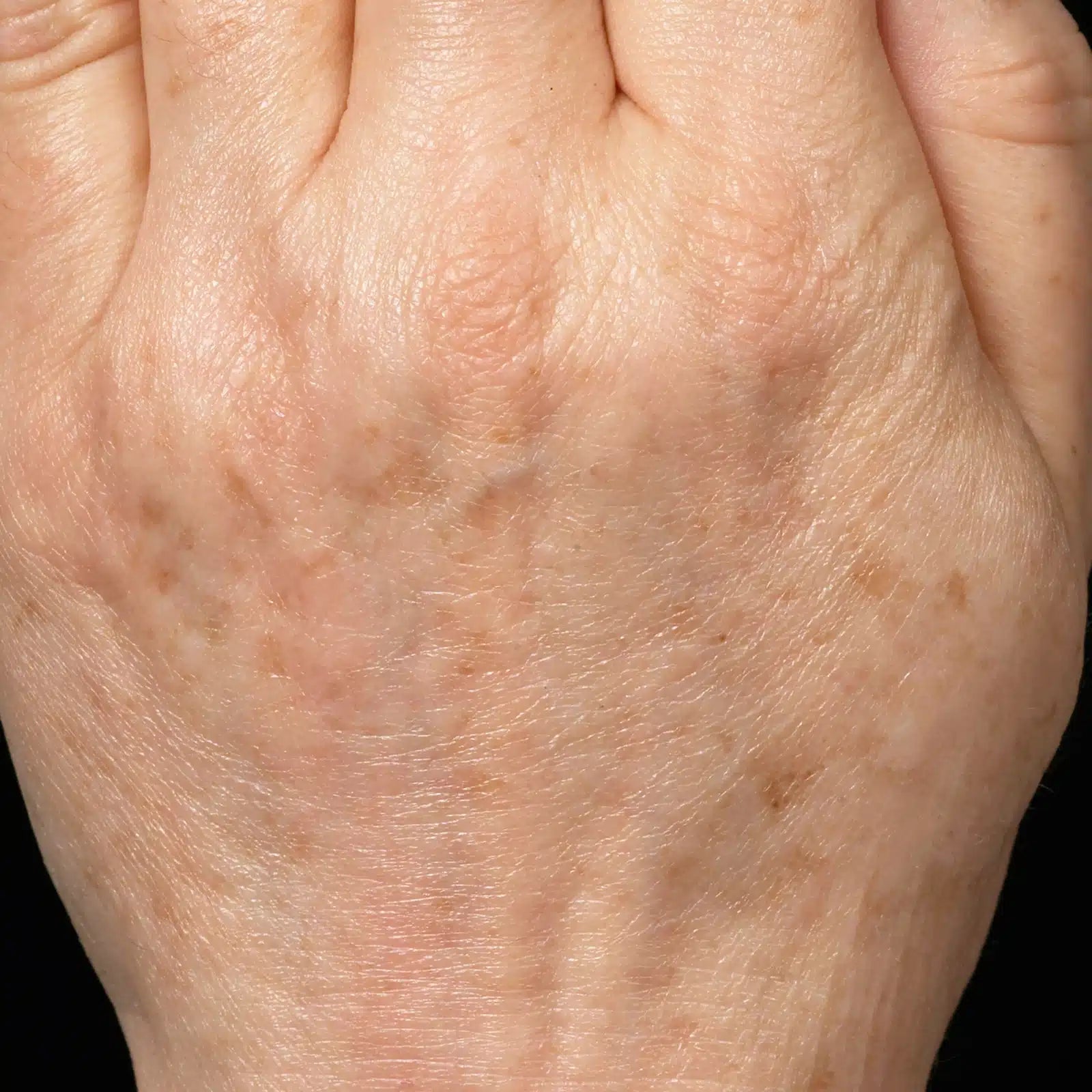 Photofacial - Hands - Allure Aesthetics
