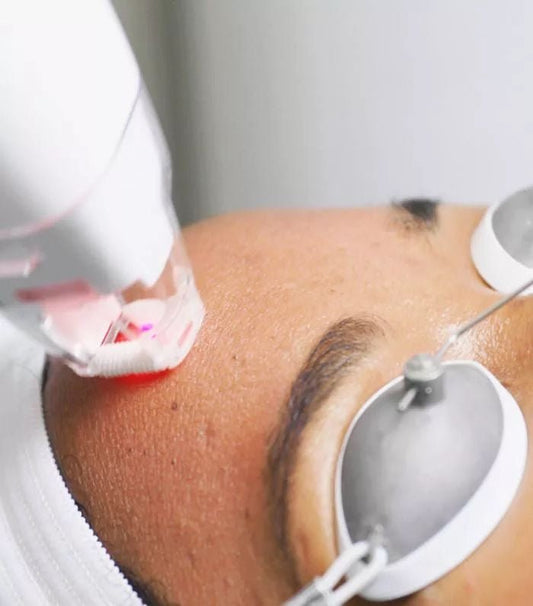 Photofacial - Spot Treatment - Allure Aesthetics