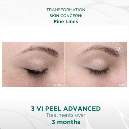 Vi Advanced Peel (office treatment) - Allure Aesthetics
