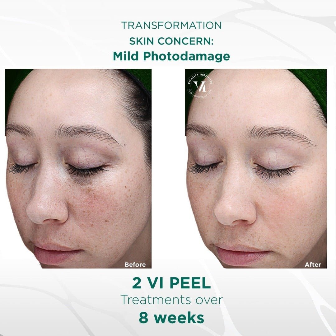 Vi Original Peel (office treatment) - Allure Aesthetics