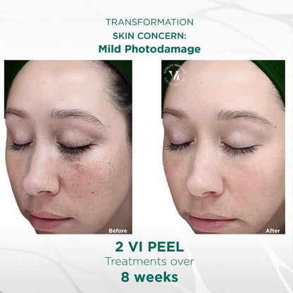 Vi Original Peel (office treatment) - Allure Aesthetics