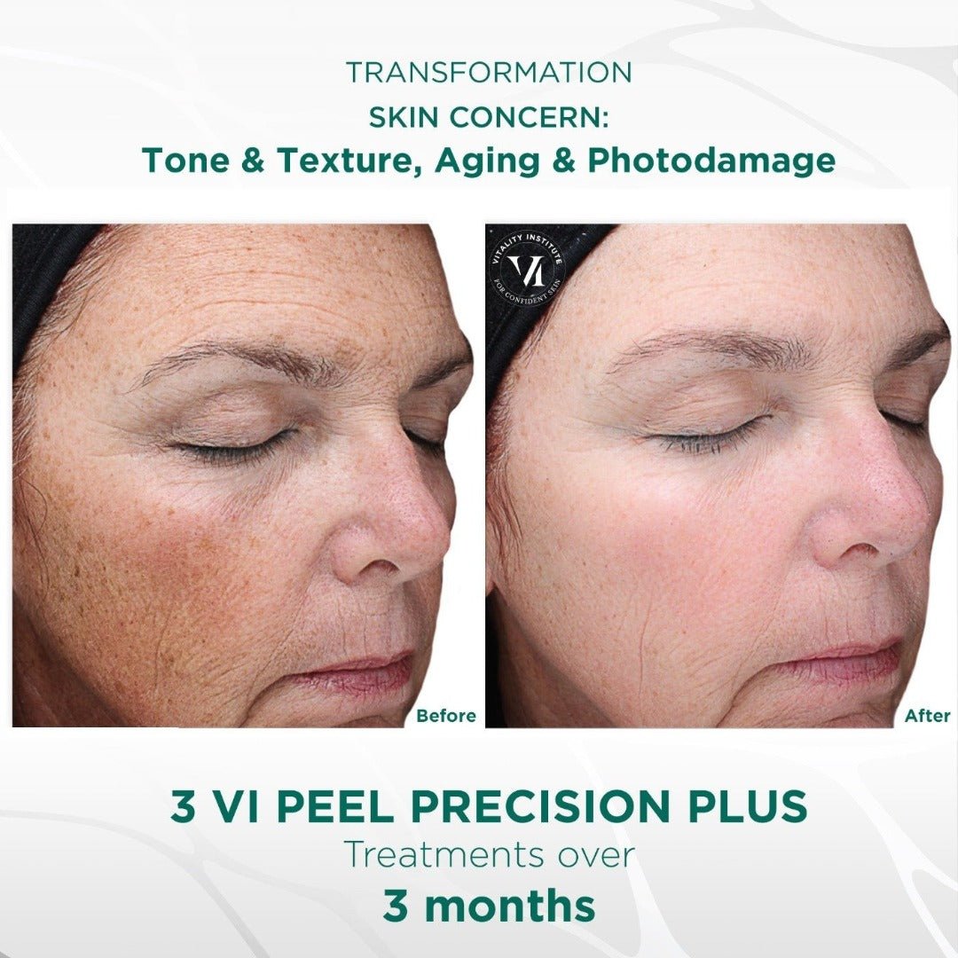 Vi Precision Plus Peel (office treatment) - Allure Aesthetics