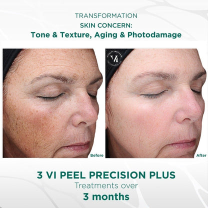 Vi Precision Plus Peel (office treatment) - Allure Aesthetics